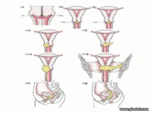 Рак шейки матки Ca Colli uteri T3N0M0