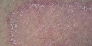 Краснота вокруг половых органов