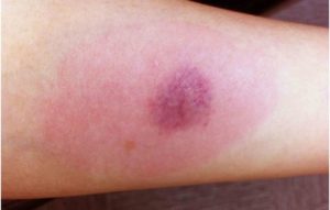 Покраснение после манту