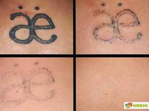 Солярий после удаления татуировки?