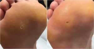 Образования типа мозолей между ягодиц