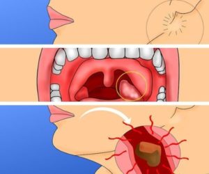 Поцарапала горло