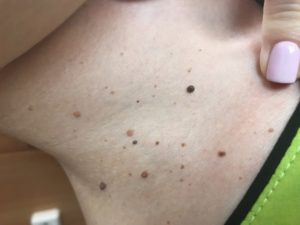 Родинка выпуклая на шее