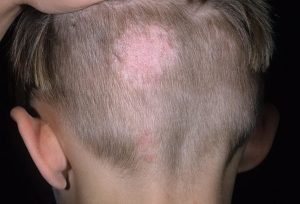 Стригущий Лишай, на его месте маленький прыщ