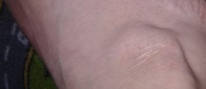 Сухая кожа на щиколотке возле косточки