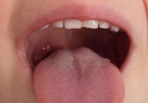 Язвочка на небе