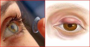 Линза закатилась под верхнее веко, она сама достанется?