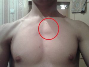 Шишка под правой грудью