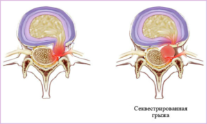 Секвестрированная грыжа