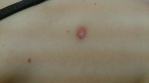 Темные пятна после ран