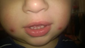 Блямба на внутренней стороне щеки