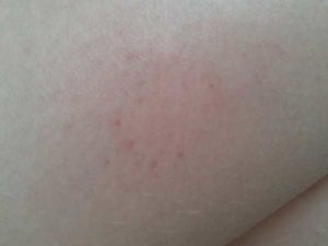 По 2 прыщика рядом и чешуться