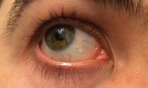 Белый шарик во внутреннем уголке глаза как жировик