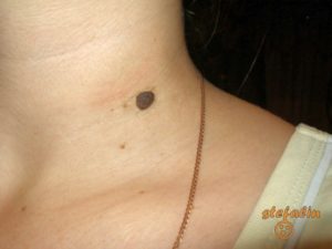 Родинка выпуклая на шее