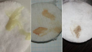 Мажущие выделения при дюфастоне, тупая боль внизу живота