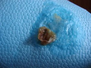 Откашливаются коричневые куски