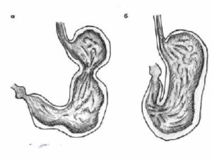 Желудок по типу песочных часов