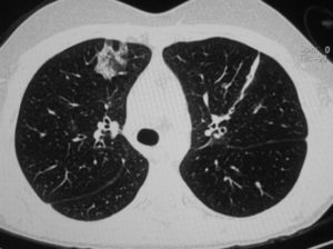 КТ грудной клетки. Астма или нет?