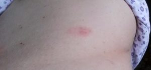 По 2 прыщика рядом и чешуться