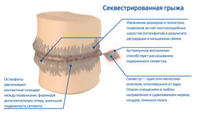 Секвестрированная грыжа