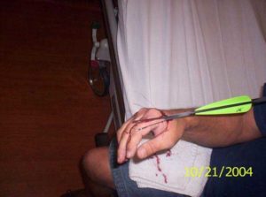 Проткнул отверткой Руку что делать