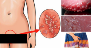 Высыпания на вульве