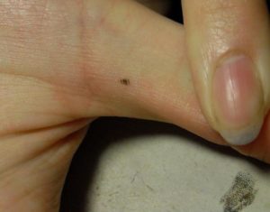 Темные пятна на пальцах рук