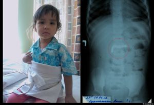 Ребенок проглотил изоленту