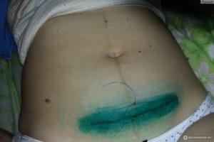 Осталась нитка после снятия швов