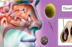 Головокружение после гайморита