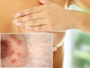 Прыщи возле соска