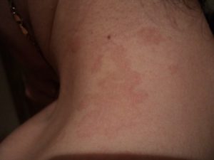 Красные пятна появляются и проподают по всему телу