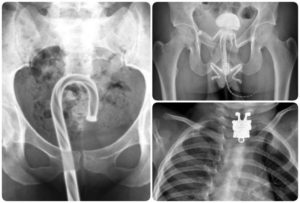 Застрял предмет в прямой кишке