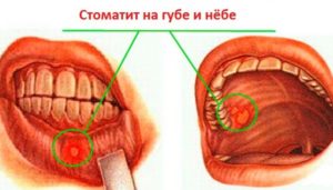 Язвочка на небе