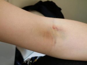 Шишка после взятия крови из вены