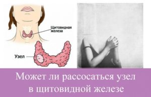 Узлы щитовидной железы