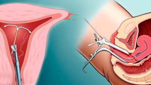 Кровит после удаления спирали