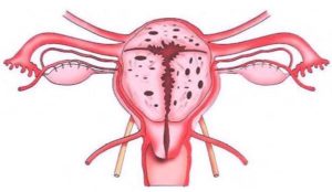 Онкомаркеры, миома матки, аденомиоз