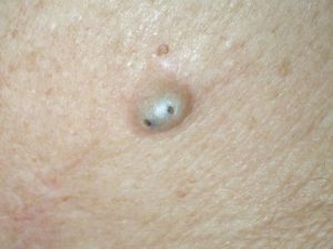 Прыщи возле соска