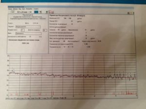 Индекс реактивности при КТГ