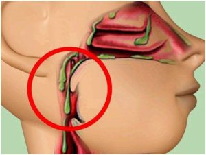 Постоянная сухость и присутствие слизи в глотке