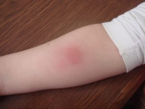 Покраснение после манту