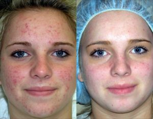 Чистка лица и пилинг при ГВ