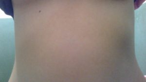 Опухоль на левой стороне ребер в низу