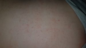 Сыпь чуть ниже груди у ребенка 12 лет