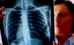 Онкология легких Помогите понять результат 7