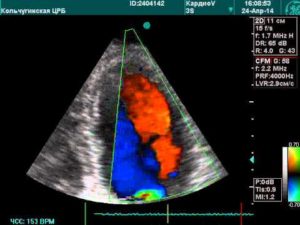 Коронарная фистула диагноз у ребенка