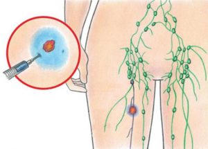 Прощупывается лимфоузел в паху