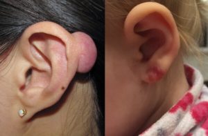 После прокола уха появилась опухоль как угорь