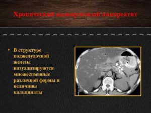 Что такое кальцинаты в поджелудочной до 3мм
